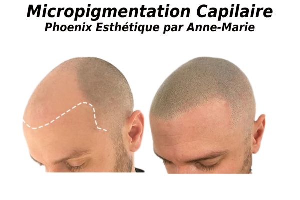 Microneedling à L'Assomption chez Phoenix Esthétique par Anne-Marie